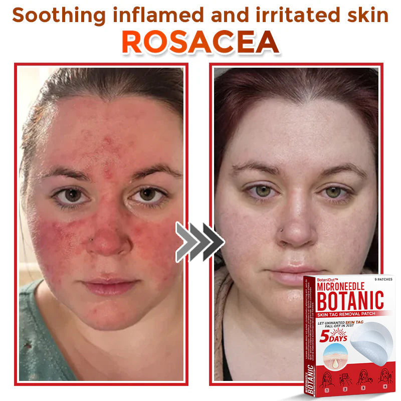 🌈BotaniDot™ MicroNeedle Botanic Skin Tag Removal Patch 🇺🇸 Made in the USA
