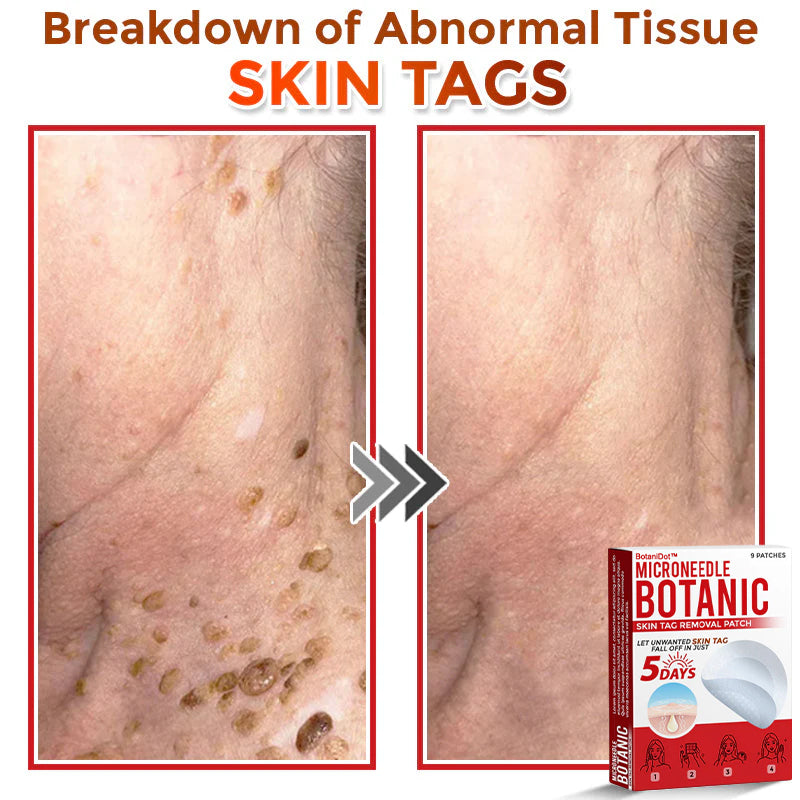 🌈BotaniDot™ MicroNeedle Botanic Skin Tag Removal Patch 🇺🇸 Made in the USA