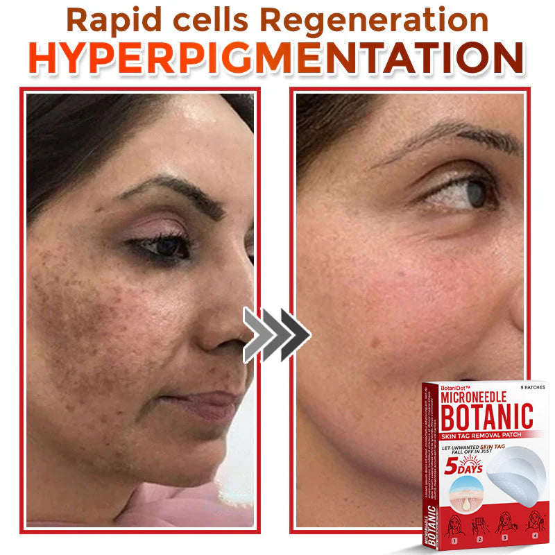 🌈BotaniDot™ MicroNeedle Botanic Skin Tag Removal Patch 🇺🇸 Made in the USA