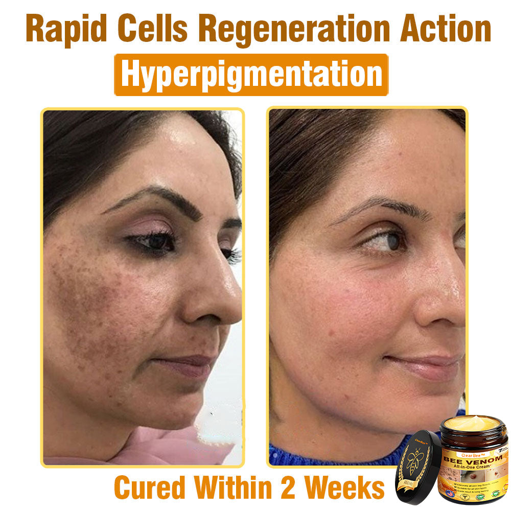 ClearBee™ Bee Venom All-in-One Cream US Dermatologist Approved🐝