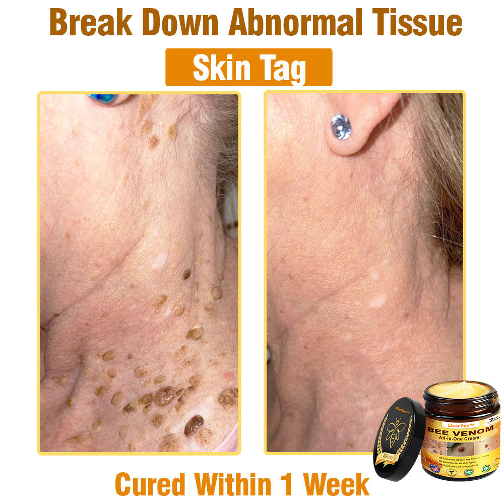 ClearBee™ Bee Venom All-in-One Cream US Dermatologist Approved🐝