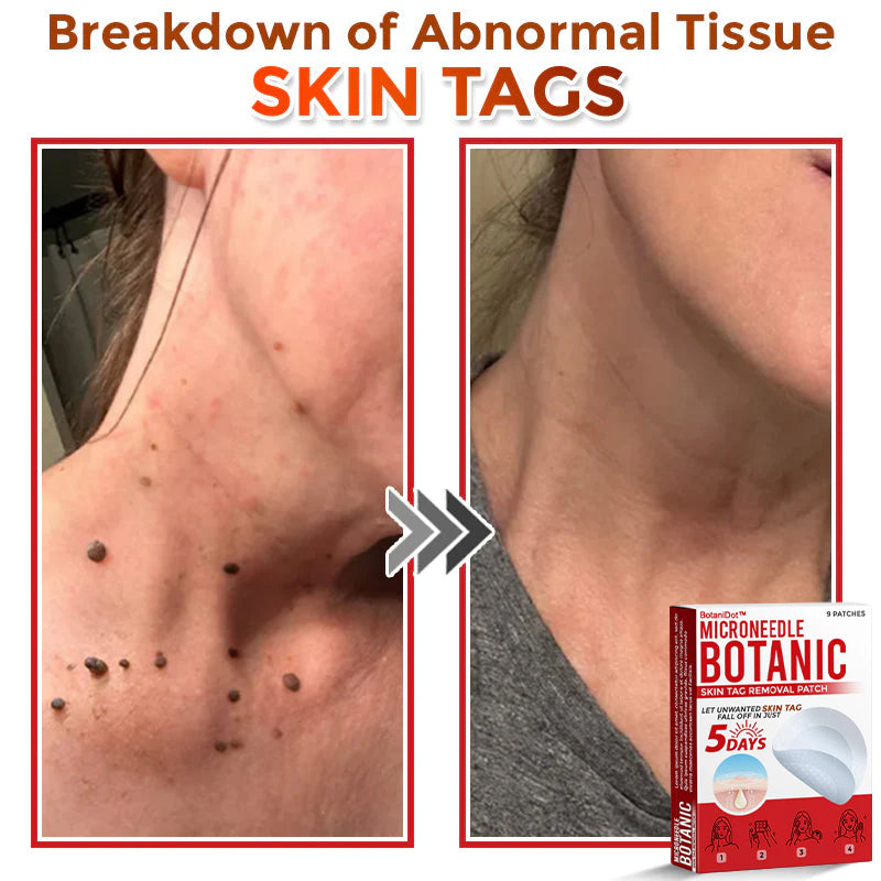 🌈BotaniDot™ MicroNeedle Botanic Skin Tag Removal Patch 🇺🇸 Made in the USA
